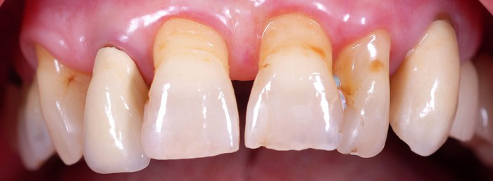 Implantate von der Zahnarztpraxis Michalides & Lang ind Bremen - Stuhr