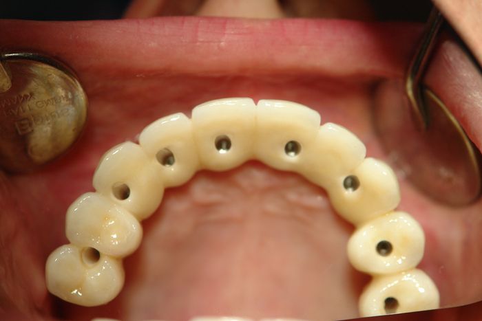 Implantate von der Zahnarztpraxis Michalides & Lang ind Bremen - Stuhr