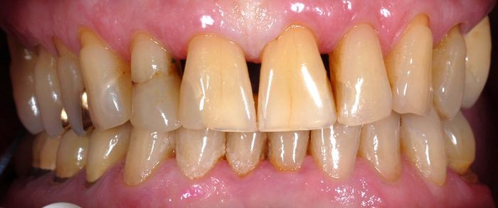 Zahn - Komplettsanierung in der Zahnarztpraxis Michalides & Lang ind Bremen - Stuhr